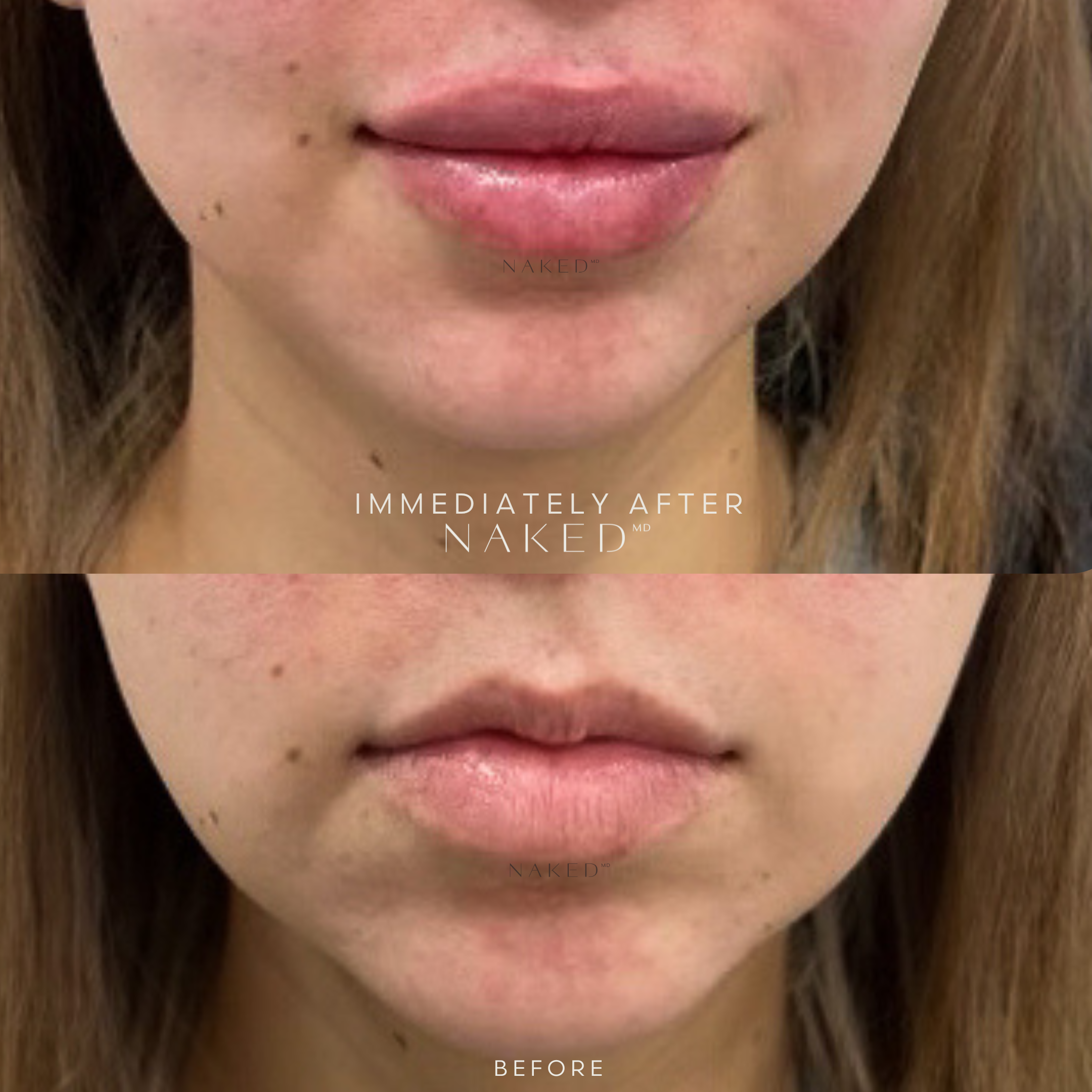 Naked Lips | Lip Filler