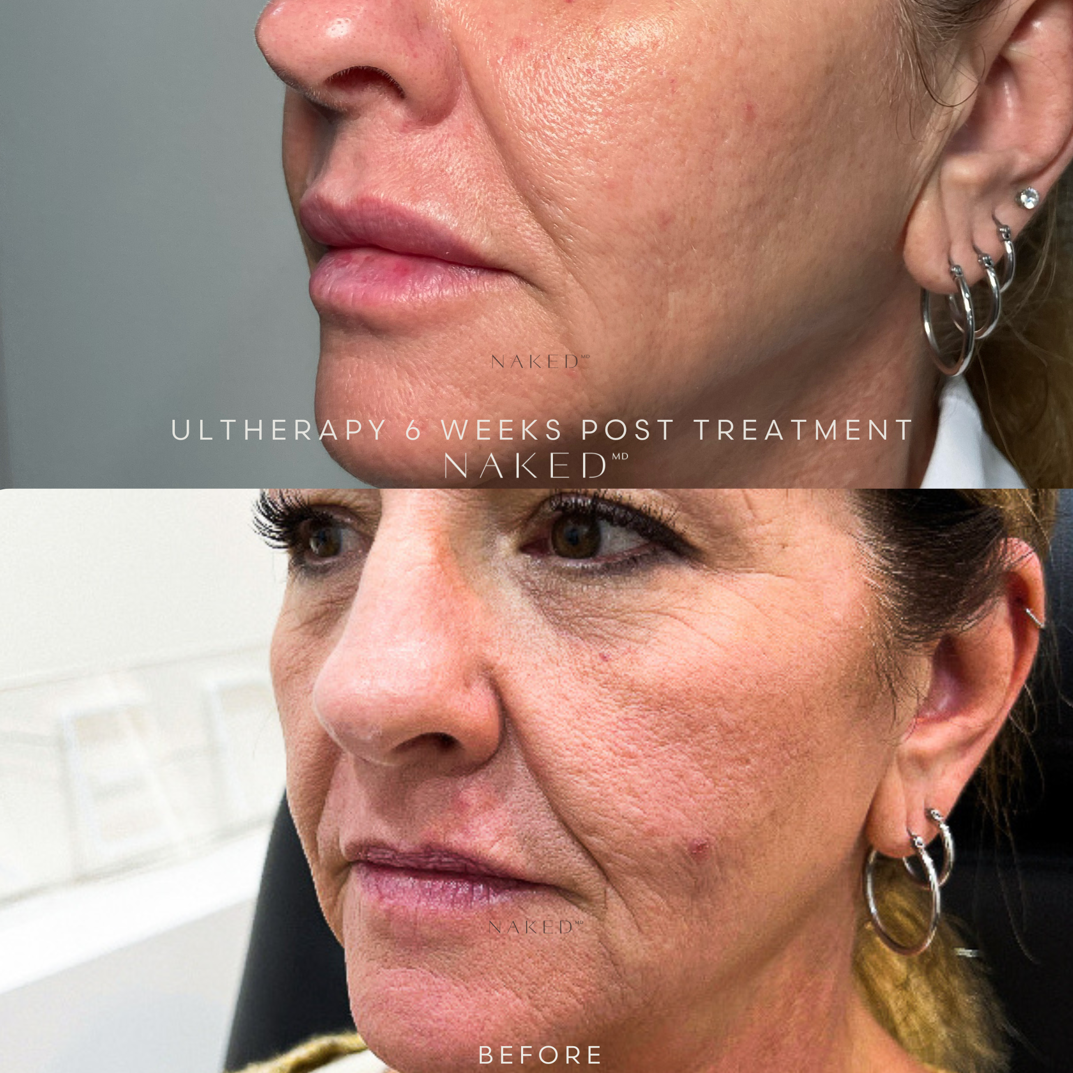 Ultherapy® Non Surgical Ultrasound Therapy