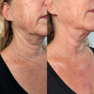 HyperDiluted Radiesse Neck Filler