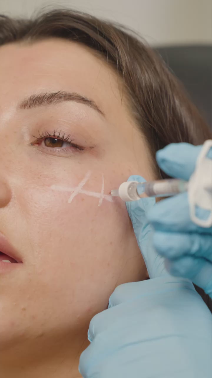 Cheek Filler