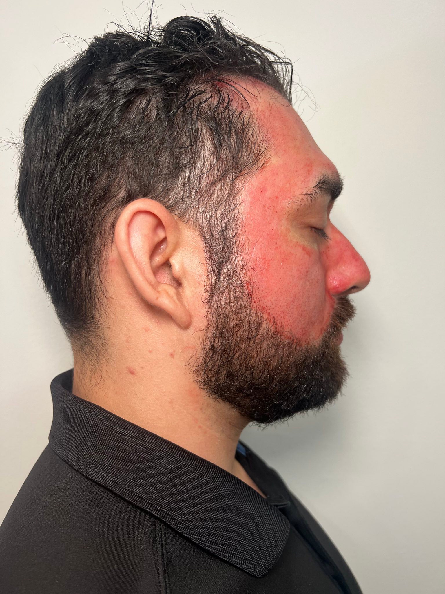 Microneedling w/ SkinPen