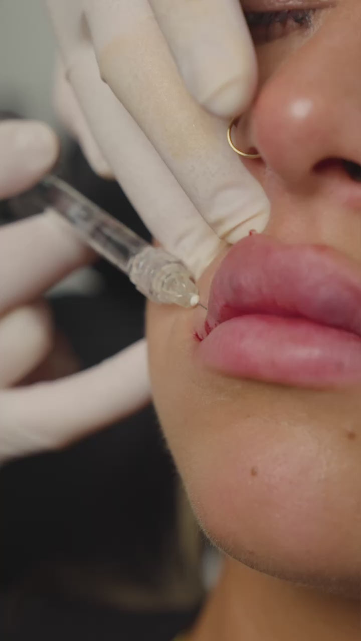 Naked Lips | Lip Filler