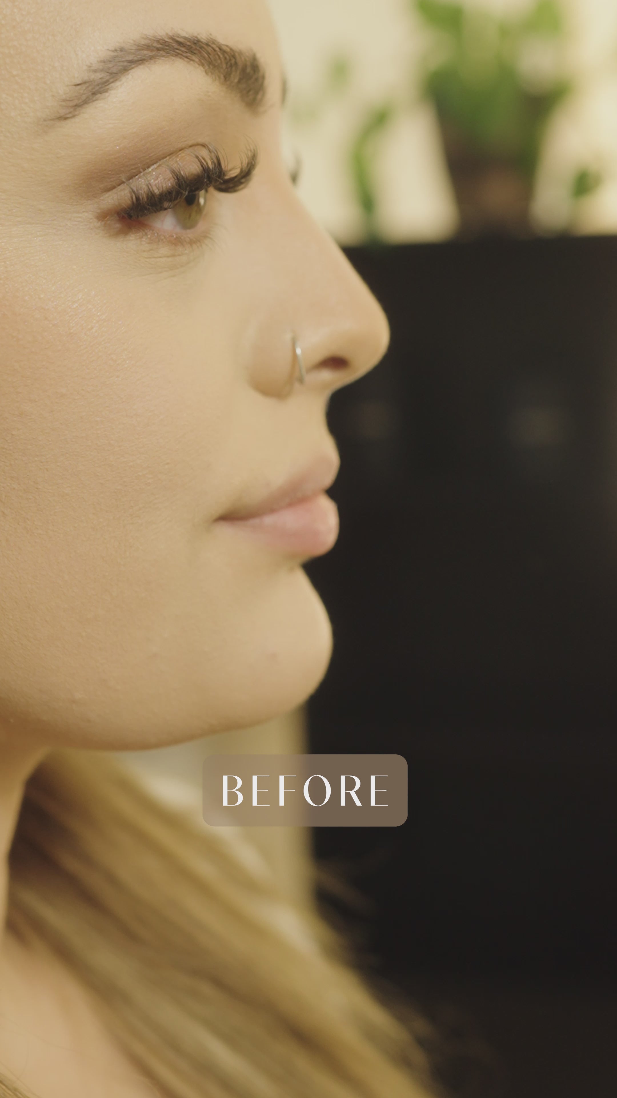 Naked Lips | Lip Filler