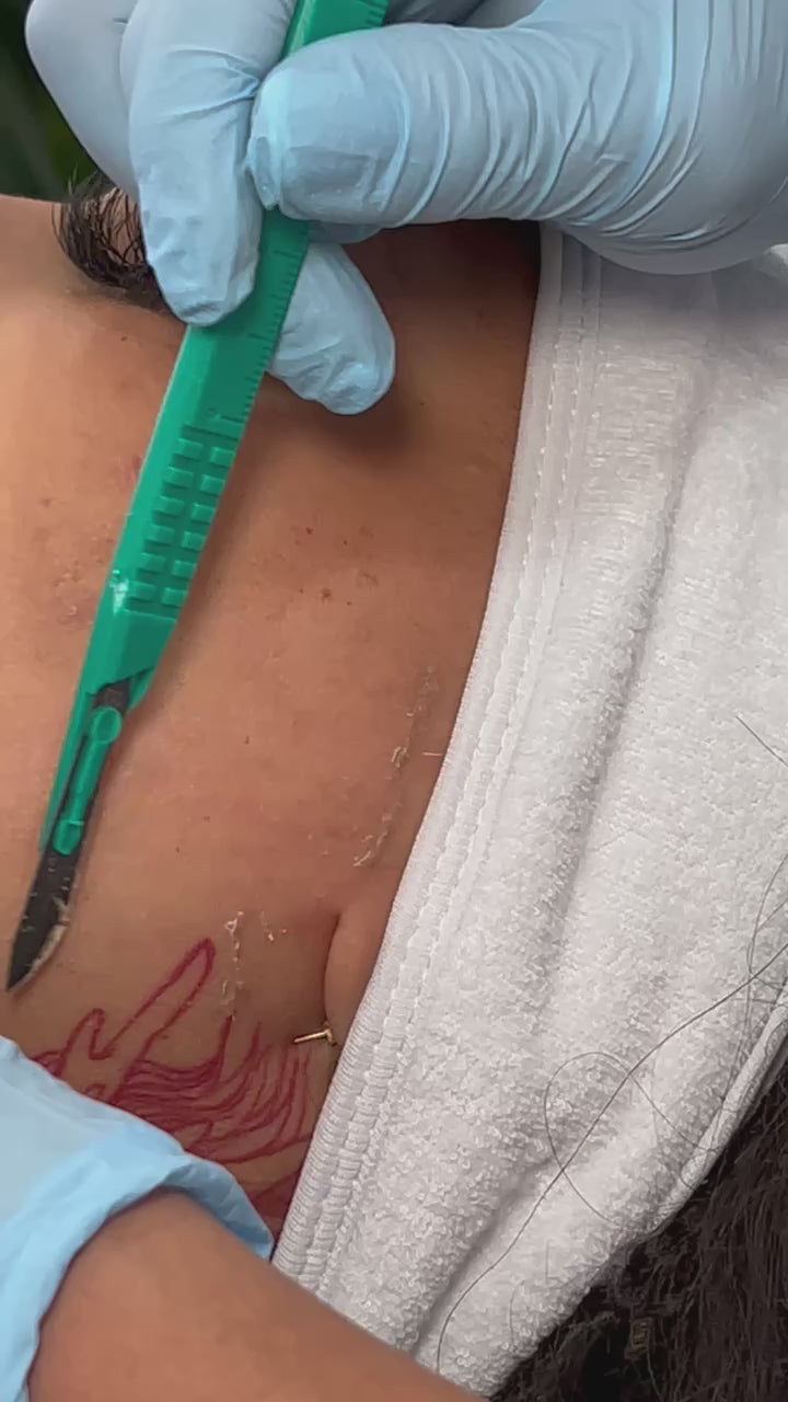 Dermaplaning