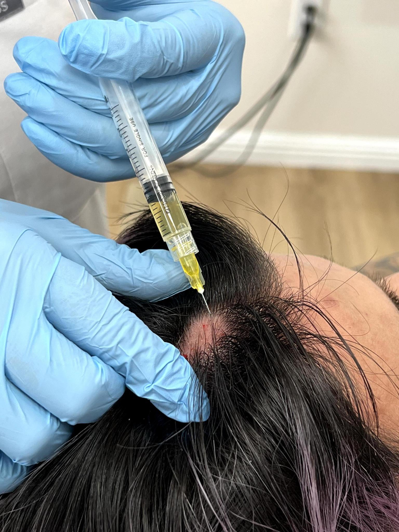 Hair Platelet Rich Plasma Injection