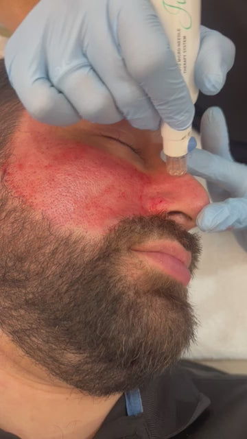Microneedling w/ SkinPen
