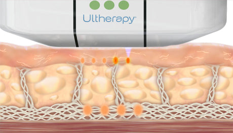 Ultherapy® Non Surgical Ultrasound Therapy