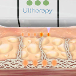 Ultherapy® | Non-Surgical Ultrasound Therapy