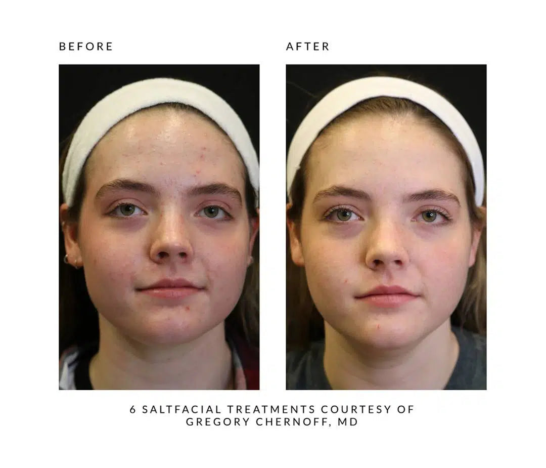 The SaltFacial®