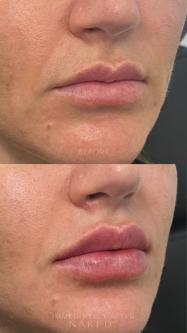 Naked Lips | Lip Filler - NV