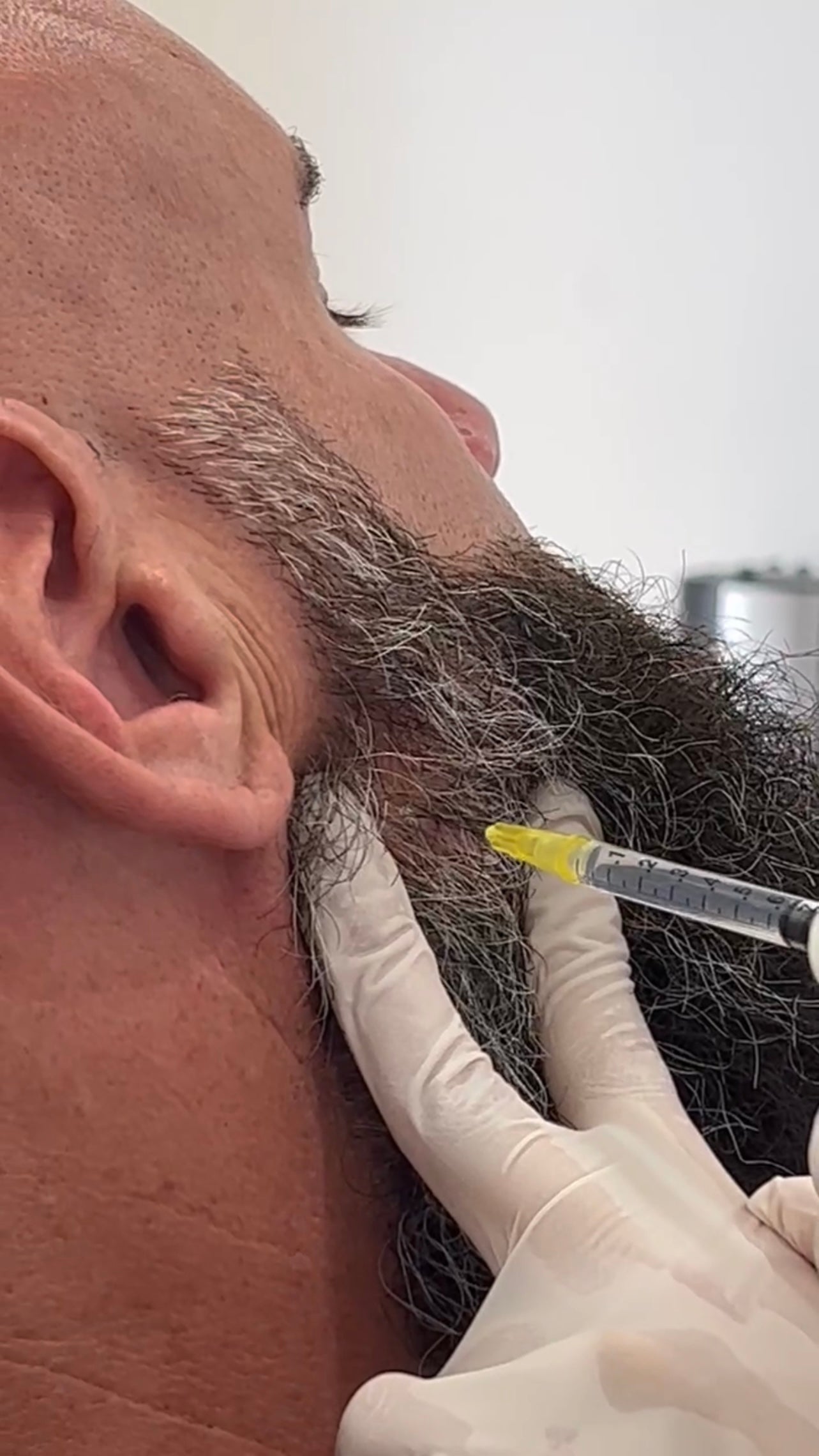 Masseter Reduction | TMJ