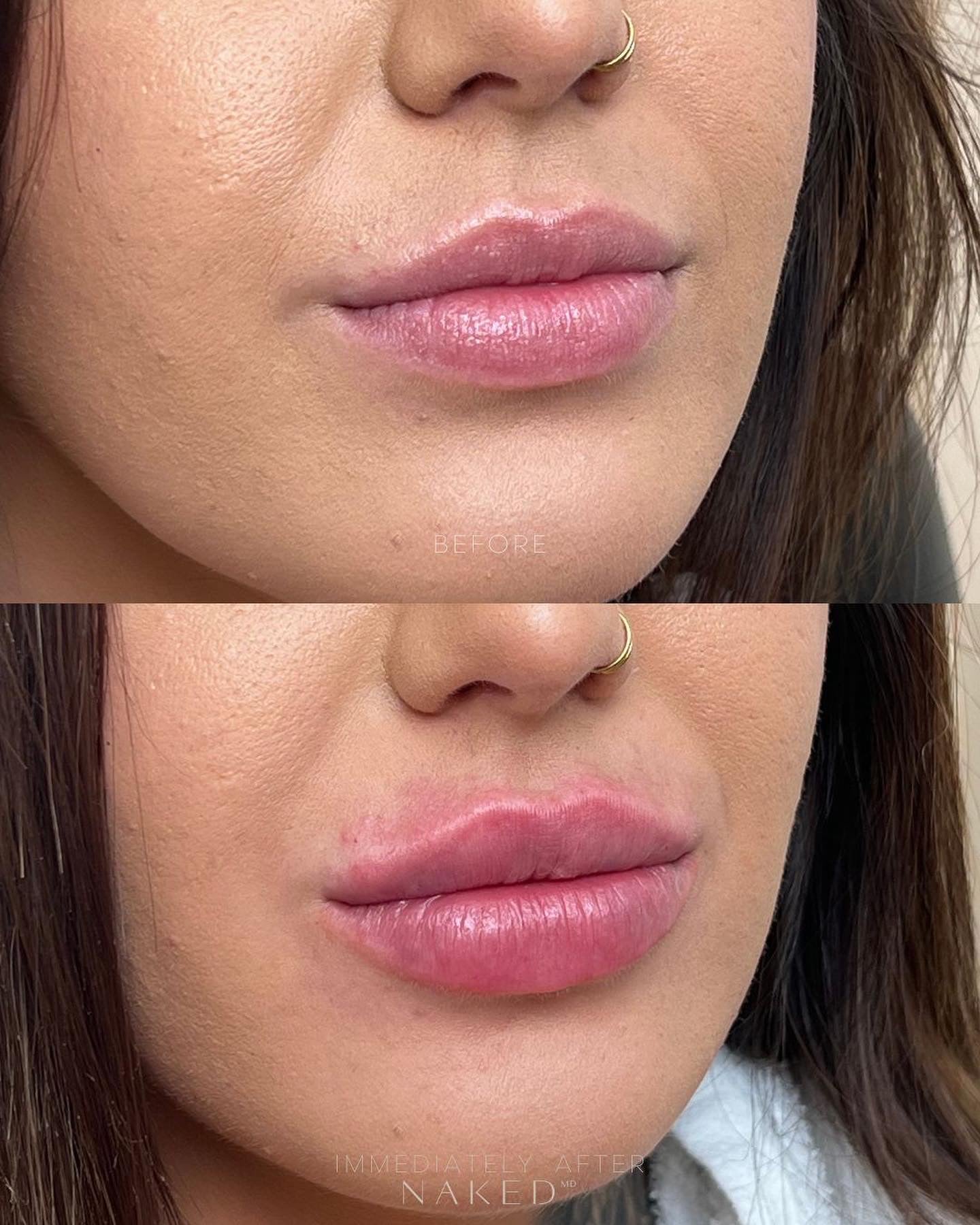 Naked Lips | Lip Filler