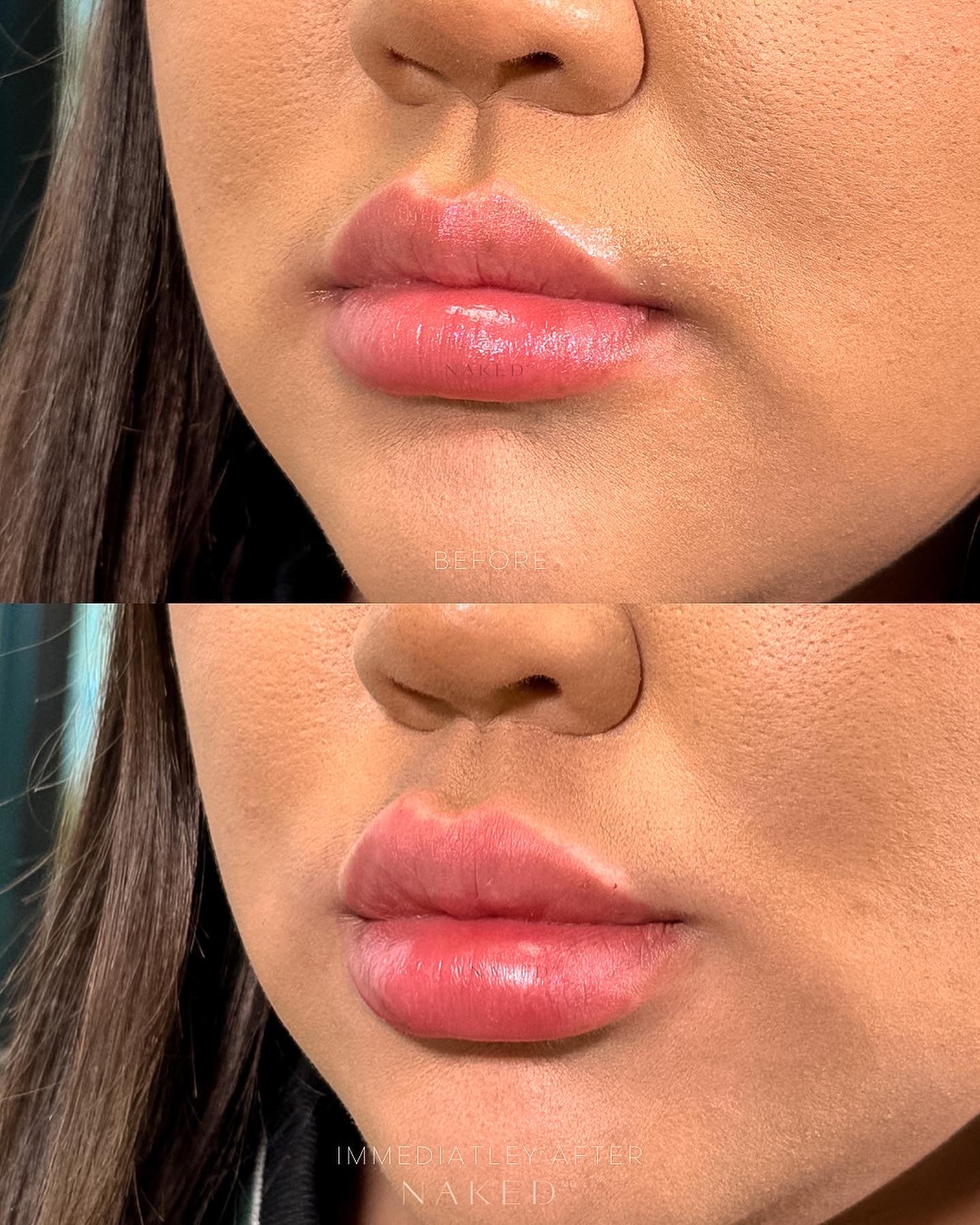 Naked Lips | Lip Filler