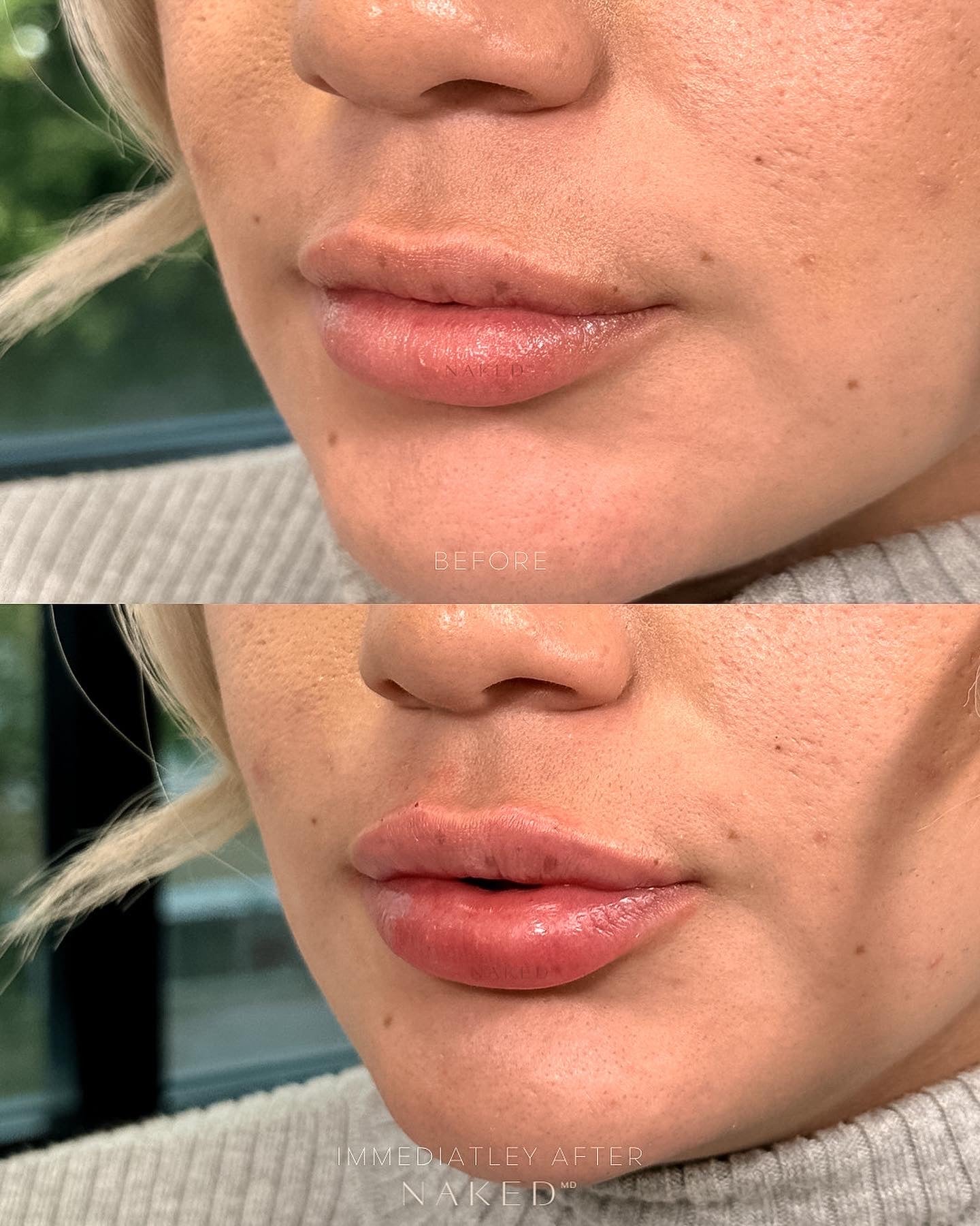 Naked Lips | Lip Filler