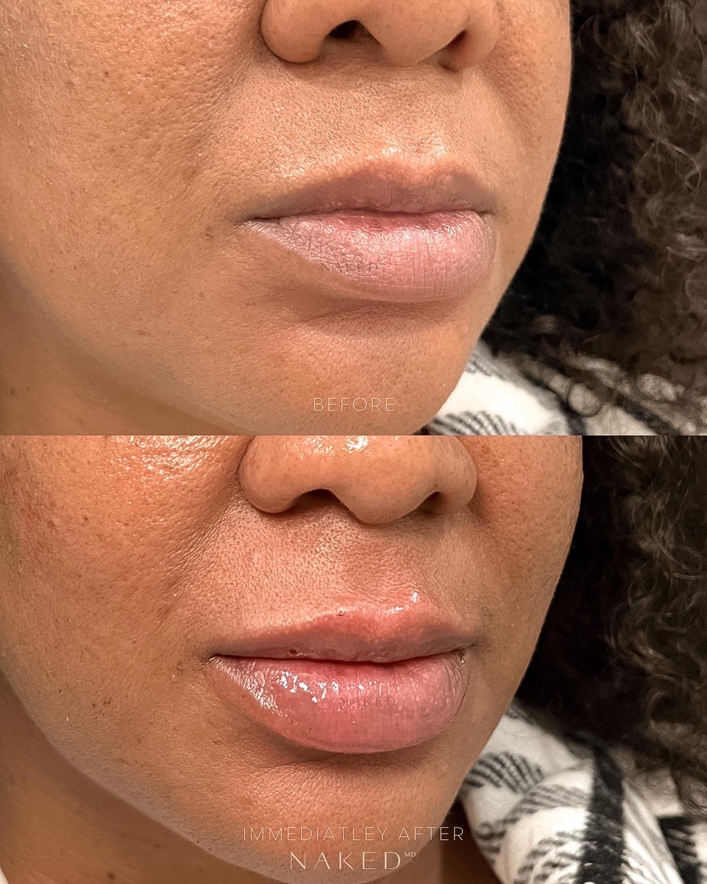 Naked Lips | Lip Filler