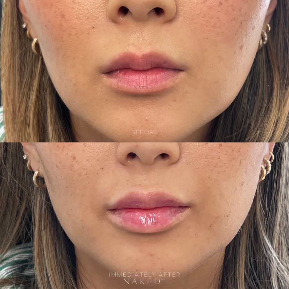 Naked Lips | Lip Filler