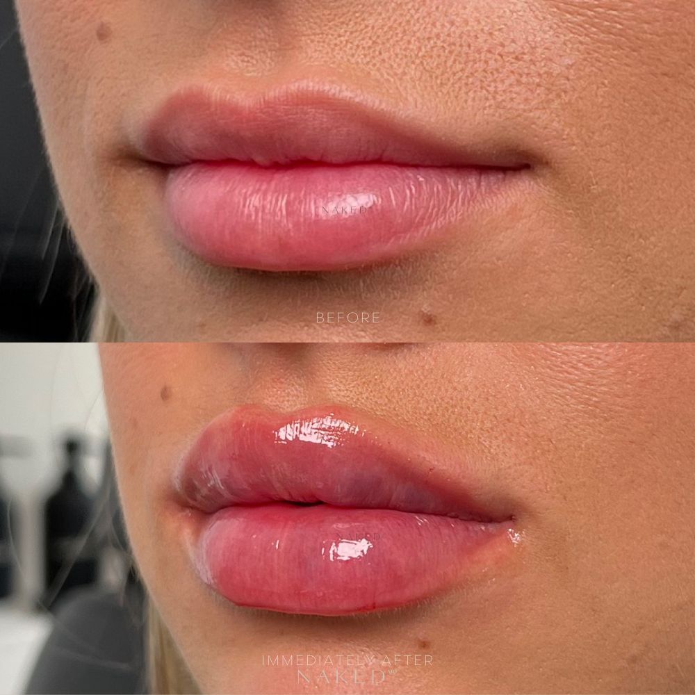 Naked Lips | Lip Filler