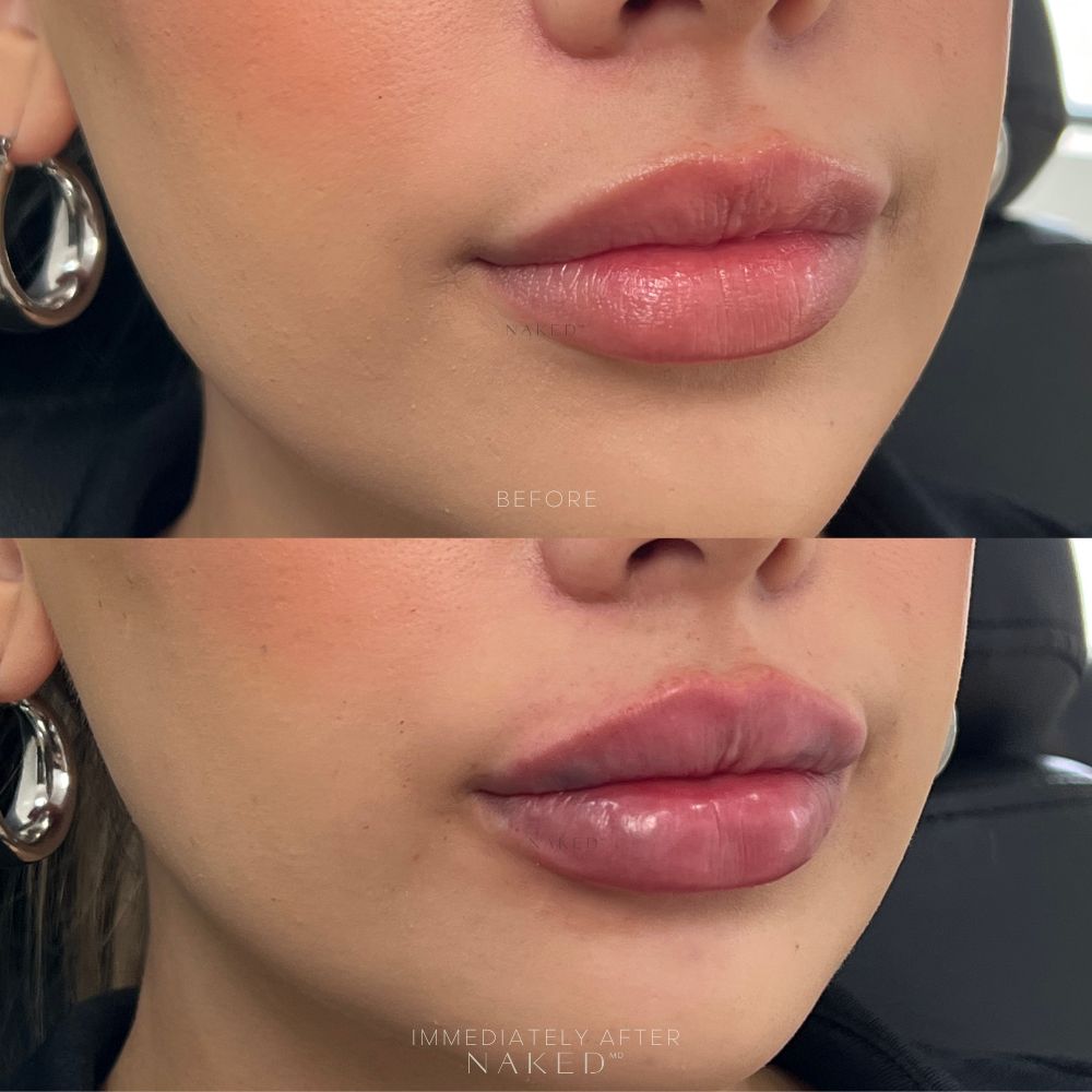 Naked Lips | Lip Filler