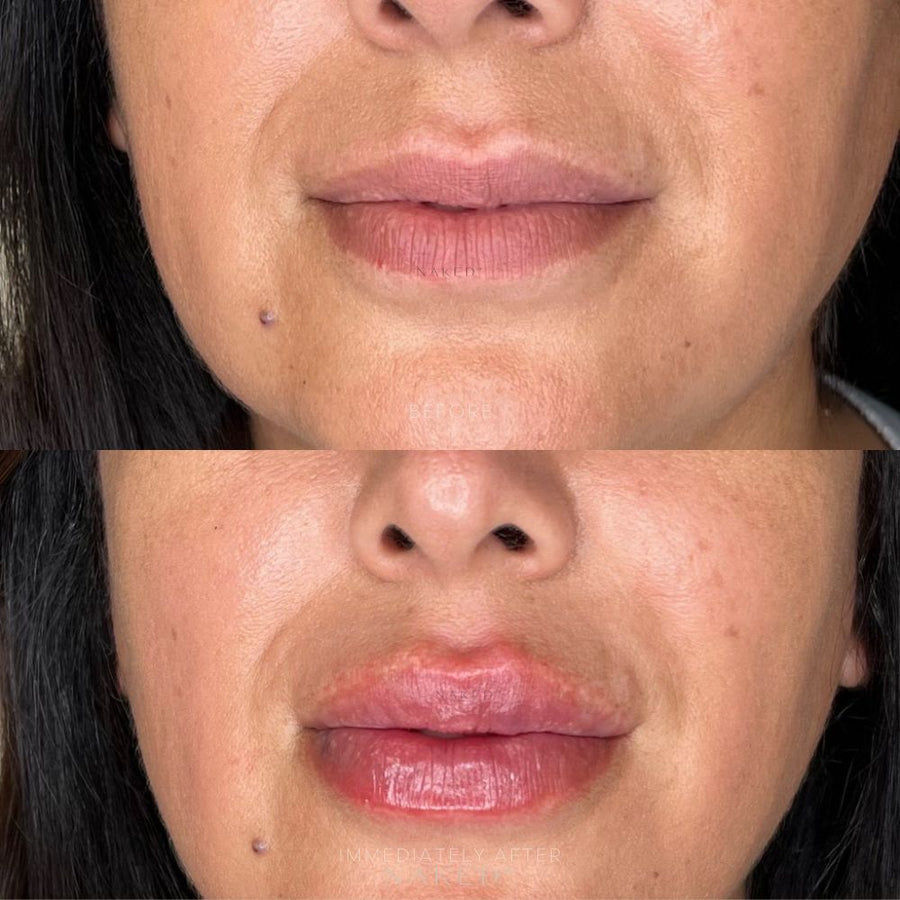 Naked Lips Lip Filler NAKEDMD Medspa