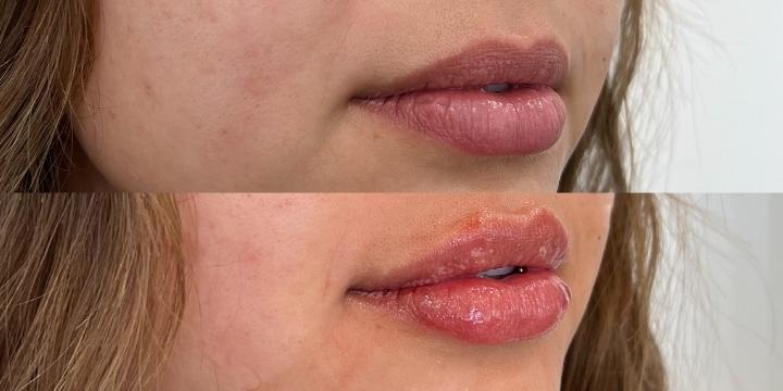 Naked Lips | Lip Filler