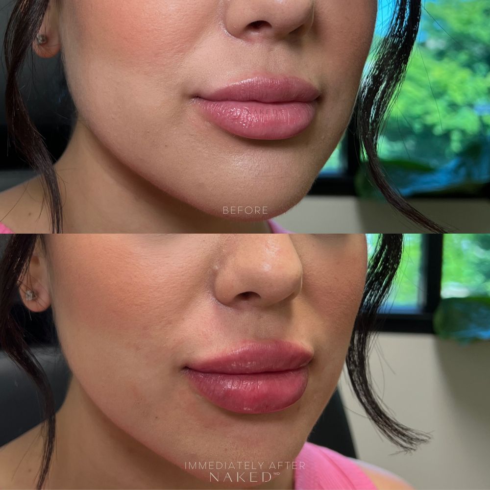 Naked Lips | Lip Filler