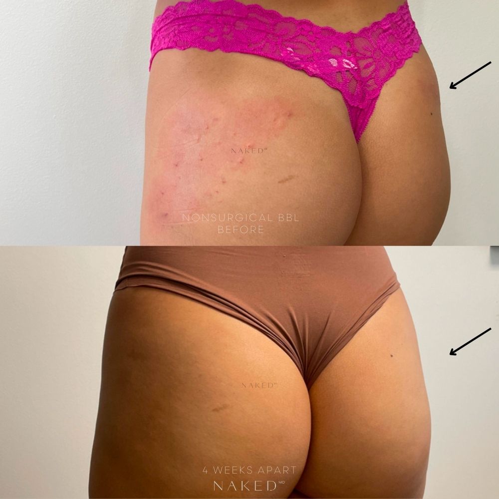 Naked Booty® Non Surgical Brazilian Butt Lift (BBL)