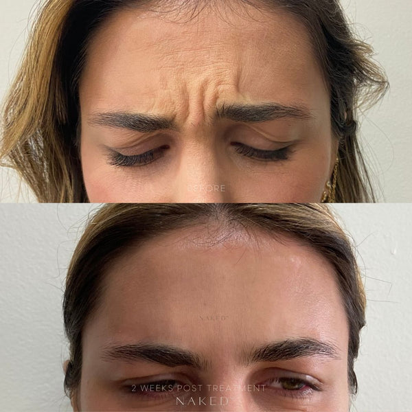 Naked TOX | Neurotoxins