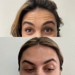 Naked TOX | Neurotoxins