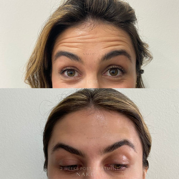 Naked TOX | Neurotoxins