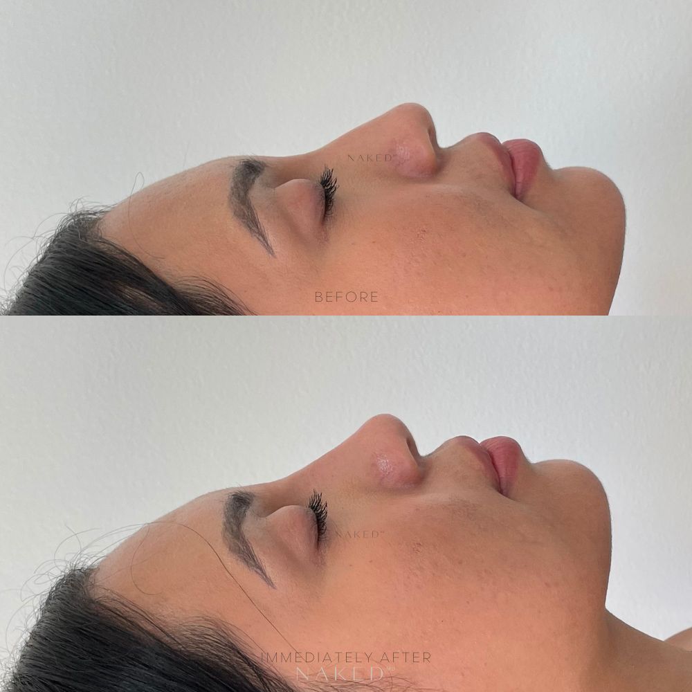 Naked Nose® | Non-Surgical Nose Job (NSNJ)
