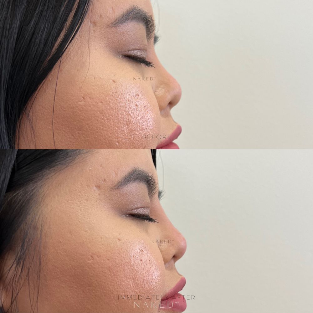 Naked Nose® | Non-Surgical Nose Job (NSNJ)
