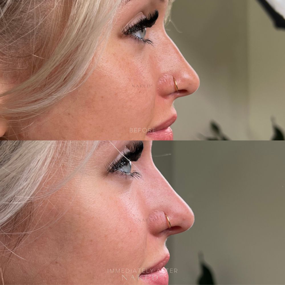 Naked Nose® | Non-Surgical Nose Job (NSNJ)