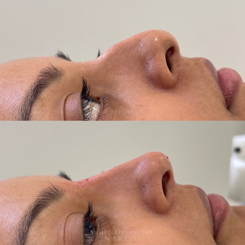 Naked Nose® | Non-Surgical Nose Job (NSNJ)