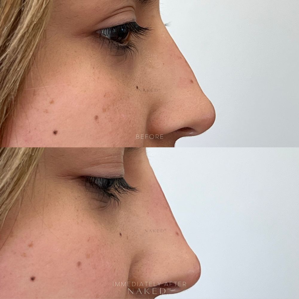 Naked Nose® | Non-Surgical Nose Job (NSNJ)
