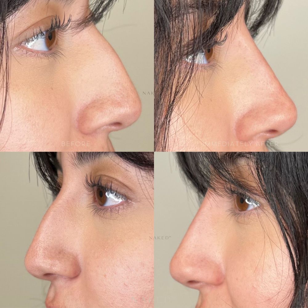 Naked Nose® | Non-Surgical Nose Job (NSNJ)