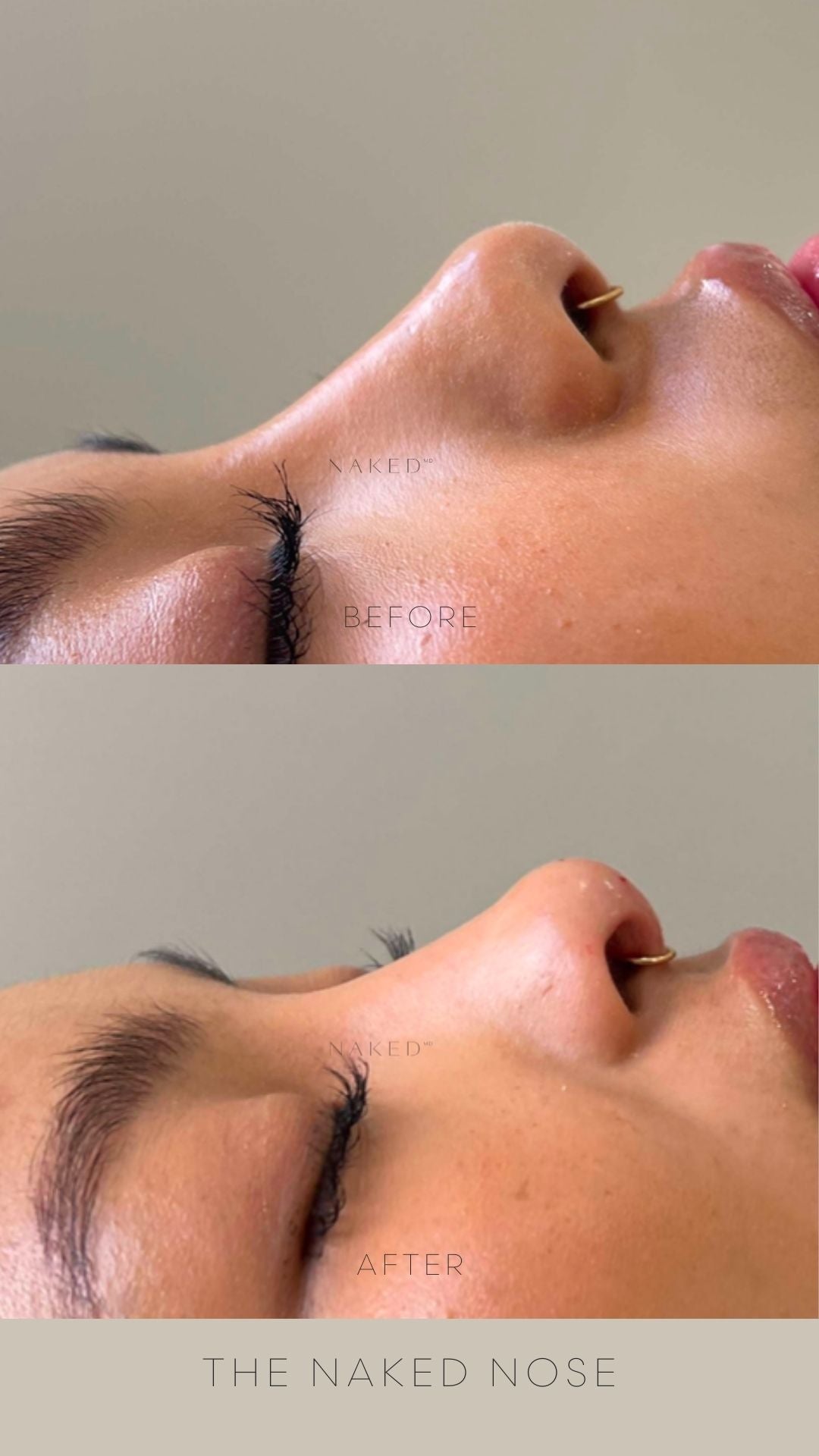 Naked Nose® | Non-Surgical Nose Job (NSNJ)