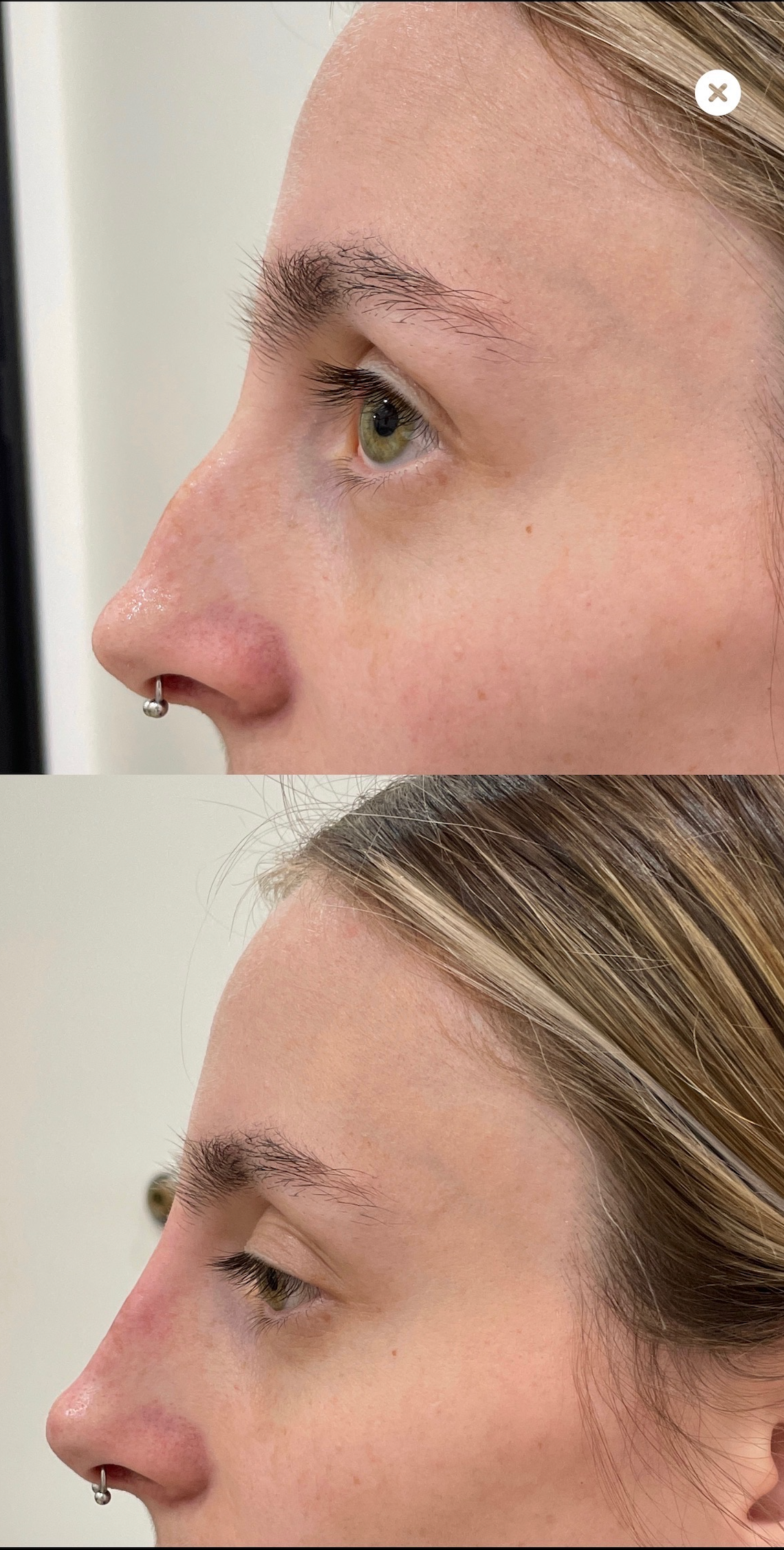 Naked Nose® | Non-Surgical Nose Job (NSNJ)