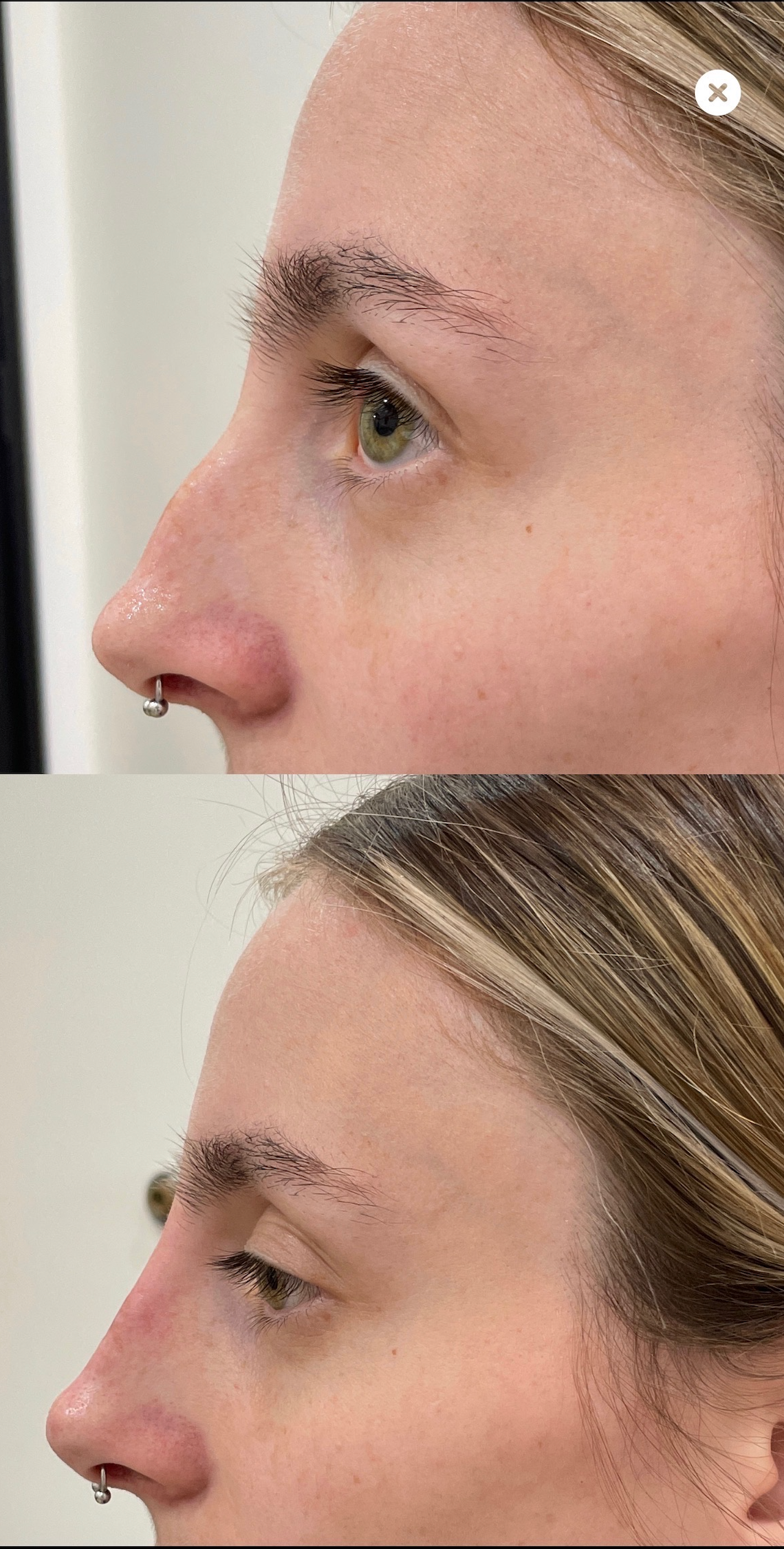 Naked Nose® Non Surgical Nose Job (NSNJ)