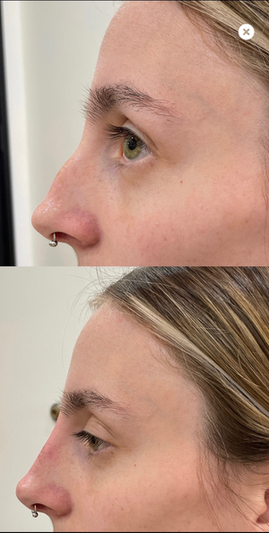 Naked Nose | Non-Surgical Nose Job (NSNJ)
