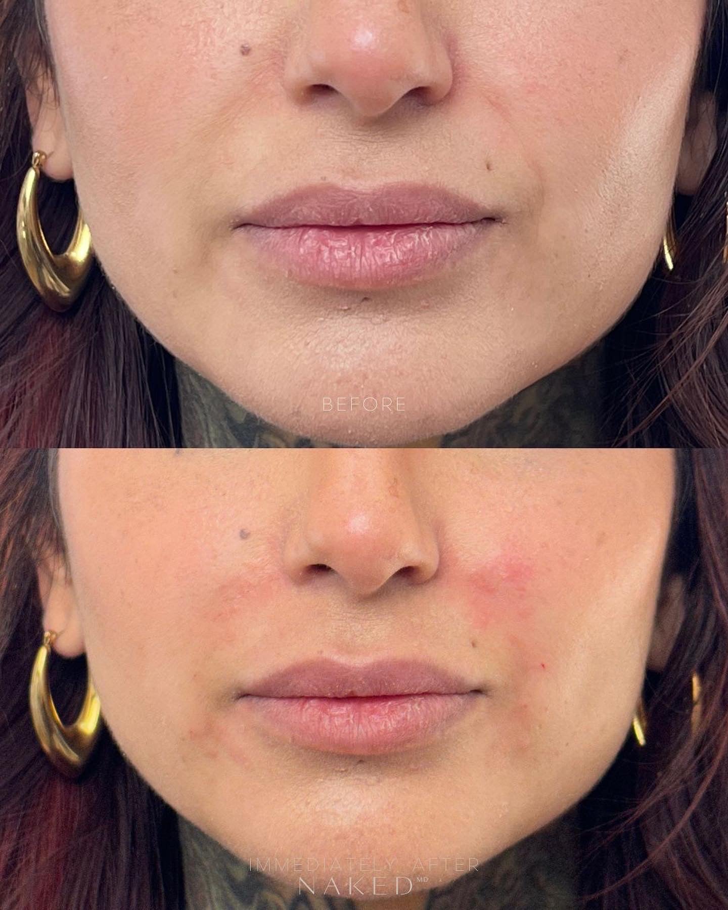 Smile Lines Filler