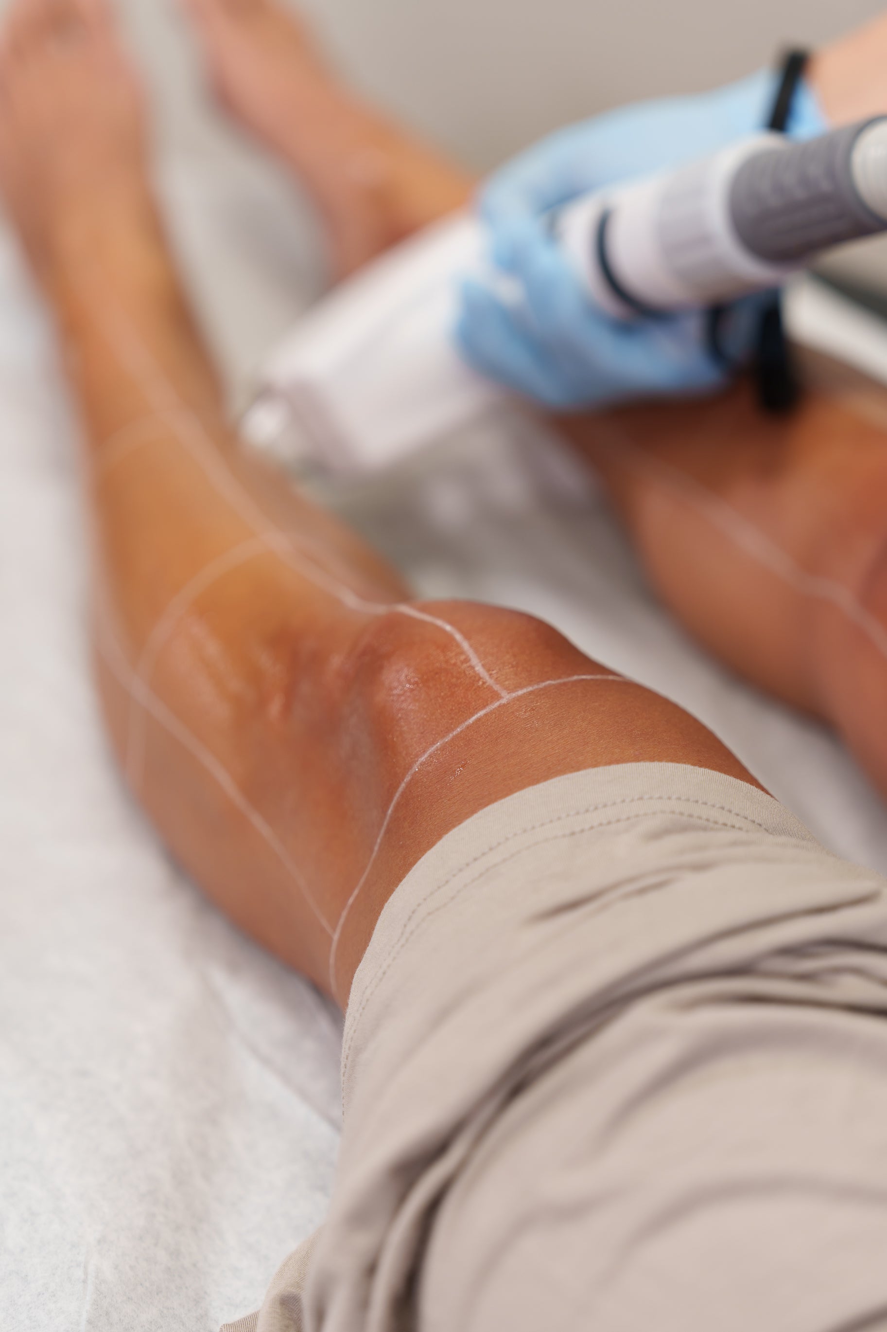 Laser Hair Removal