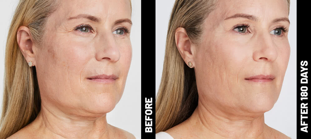 Ultherapy® Non Surgical Ultrasound Therapy