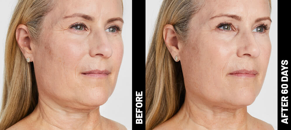 Ultherapy® Non Surgical Ultrasound Therapy