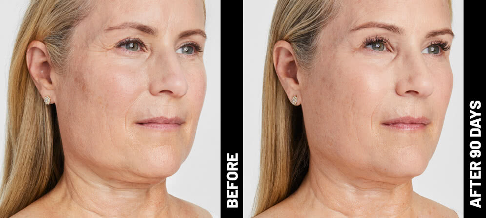 Ultherapy® Non Surgical Ultrasound Therapy