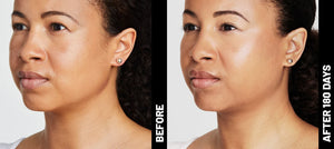 Ultherapy® | Non-Surgical Ultrasound Therapy