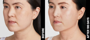 Ultherapy® | Non-Surgical Ultrasound Therapy