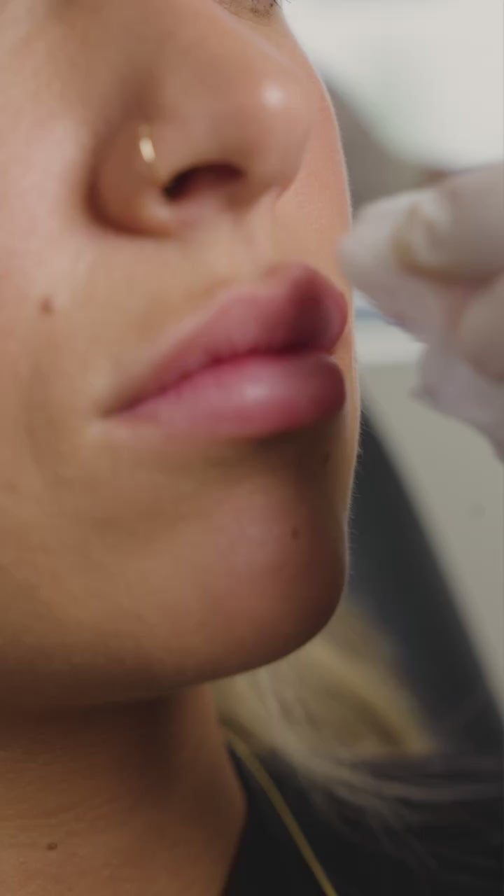 Naked Lips | Lip Filler