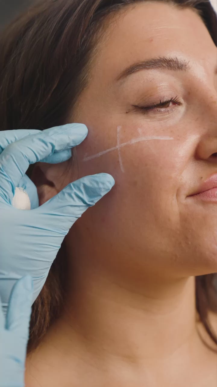 Cheek Filler