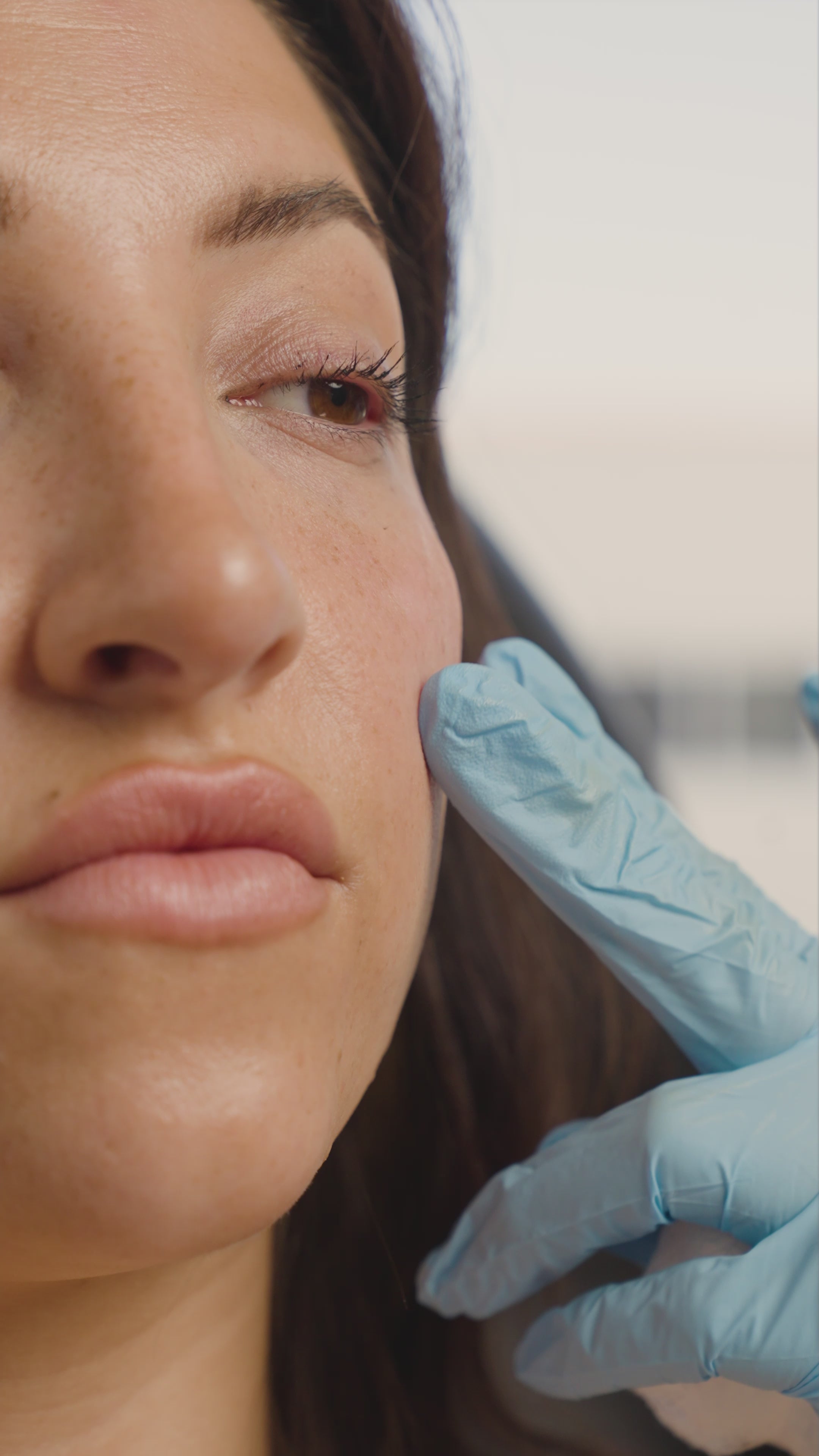 Cheek Filler