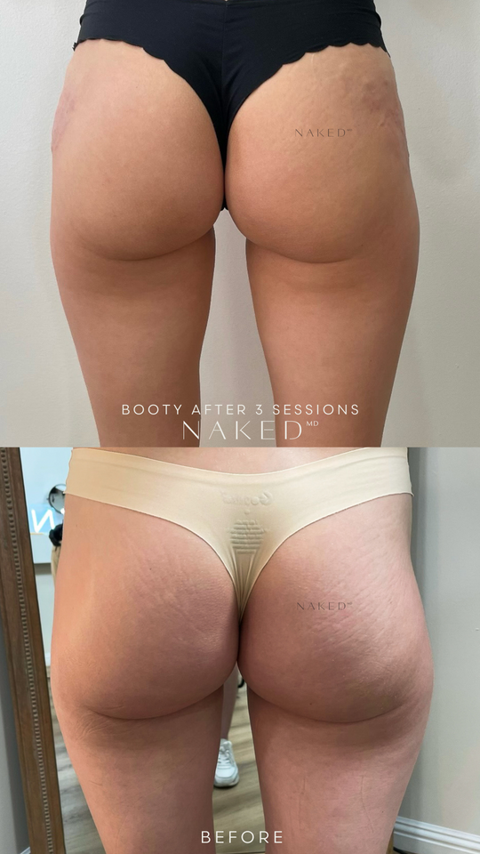 Non Surgical BBL | Butt Lift in California and Arizona – NAKEDMD Medspa